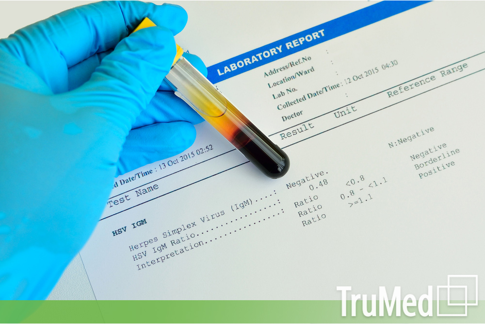 blood-sample-with-hsv-herpes-simplex-virus-testing-result